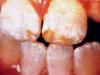 fluorosis teeth