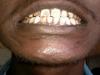 Dental fluorosis