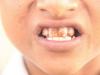 dental fluorosis