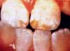 fluorosis teeth