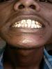 Dental fluorosis