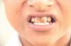 dental fluorosis